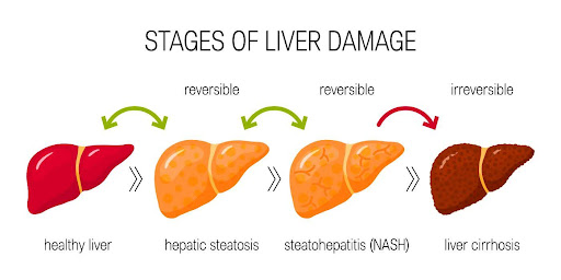 A chart showing stages of liver damage